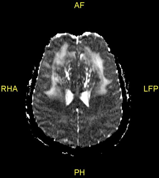 File:Butterfly glioma (Radiopaedia 76707-88526 Axial ADC 18).jpg