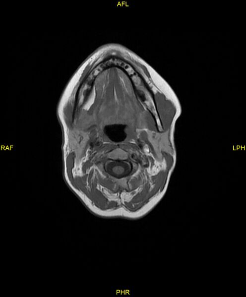File:C5 nerve sheath tumor (Radiopaedia 85777-101596 Axial T1 6).jpg