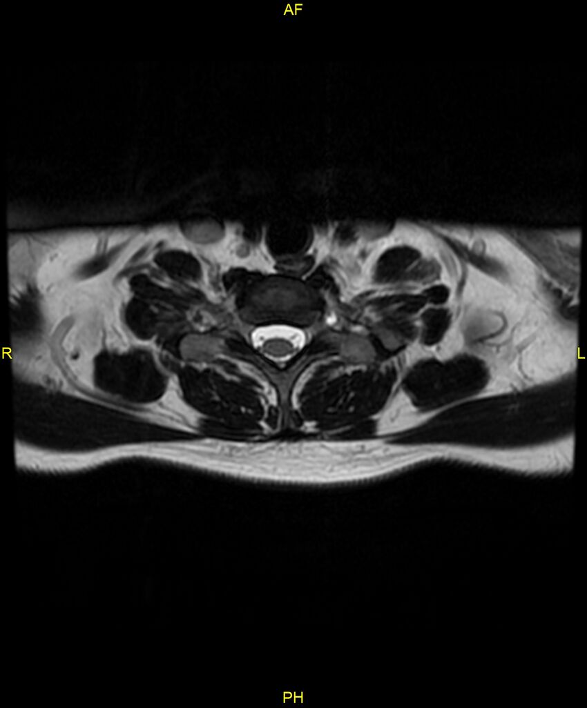C5 nerve sheath tumor (Radiopaedia 85777-101596 Axial T2 69).jpg