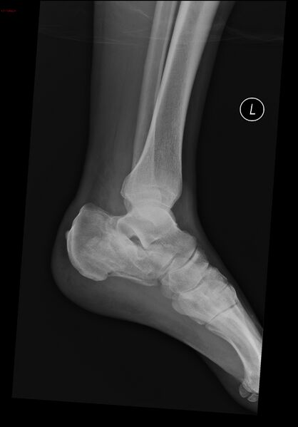 File:Calcaneal fracture and associated spinal injury (Radiopaedia 17896-17655 Lateral 1).jpg