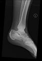 Calcaneal fracture and associated spinal injury (Radiopaedia 17896-17655 Lateral 1).jpg