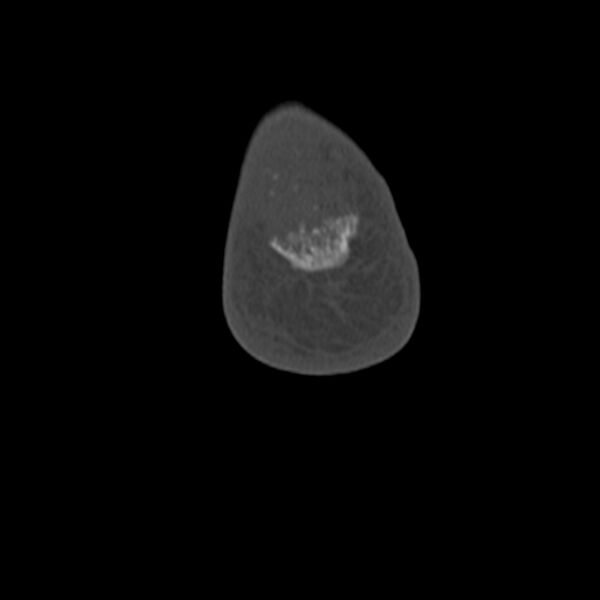 File:Calcaneal tuberosity avulsion fracture (Radiopaedia 22649-22668 Coronal bone window 69).jpg