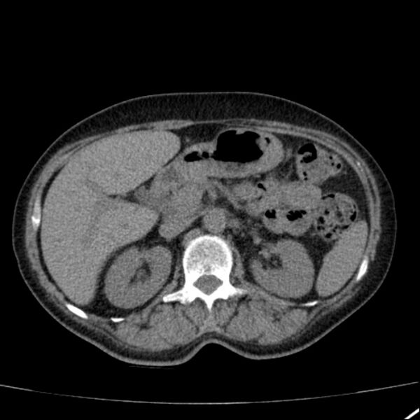 File:Calcified hepatic hydatid cyst (Radiopaedia 26872-27046 Axial non-contrast 31).jpg