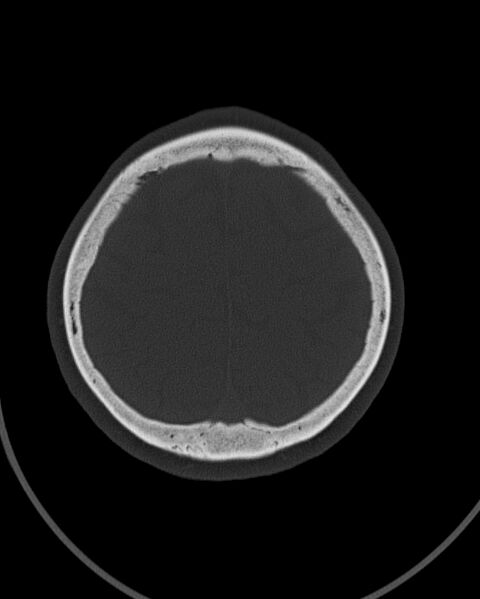 File:Calcified meningioma (Radiopaedia 74361-85243 Axial bone window 3).jpg