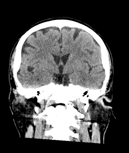 File:Calcified meningioma (Radiopaedia 74361-85243 Coronal non-contrast 26).jpg