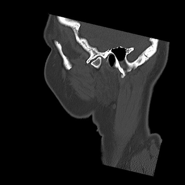 File:Canal up mastoidectomy (Radiopaedia 78108-90638 Sagittal bone window 9).jpg