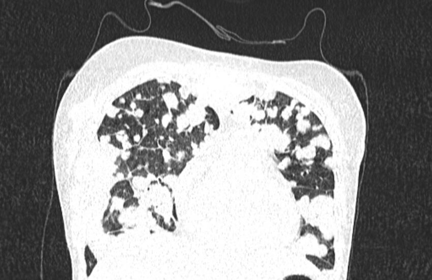 Cannonball metastases from breast cancer (Radiopaedia 91024-108569 Coronal lung window 35).jpg