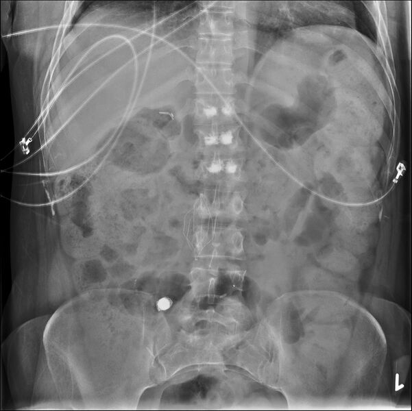 File:Capsule endoscopy and IVC filter on abdominal x-ray (Radiopaedia 27523-27727 B 1).jpg