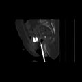 Carcinoma cervix- brachytherapy applicator (Radiopaedia 33135-34173 Sagittal bone window 91).jpg
