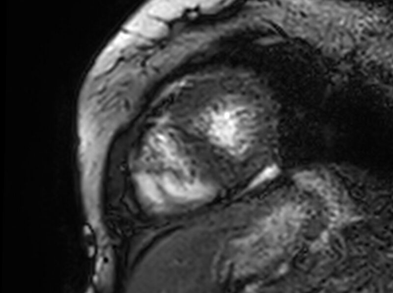 File:Cardiac amyloidosis (Radiopaedia 61600-69579 Short axis bSSFP 85).jpg