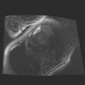 Cardiac fibroma (Radiopaedia 38974-41150 4 chamber FGRET 23).jpg
