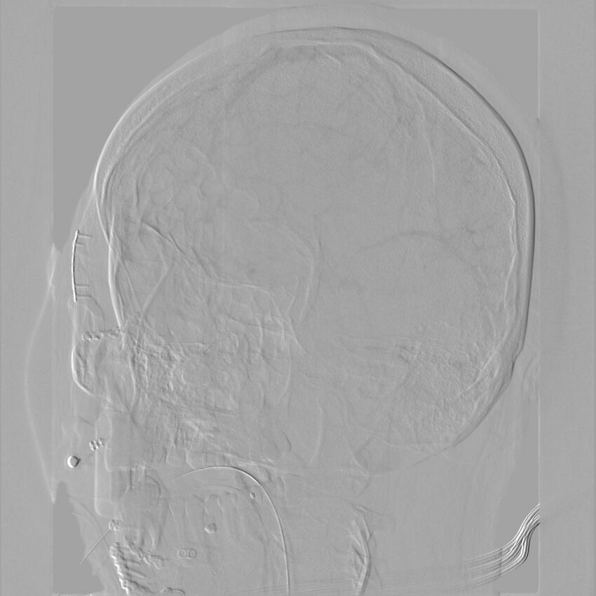Caroticocavernous fistula - direct (Radiopaedia 61660-69666 Oblique Left ICA 53).jpg