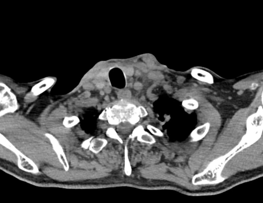 Carotid artery pseudoaneurysm (Radiopaedia 84030-99259 Axial non-contrast 51).jpg