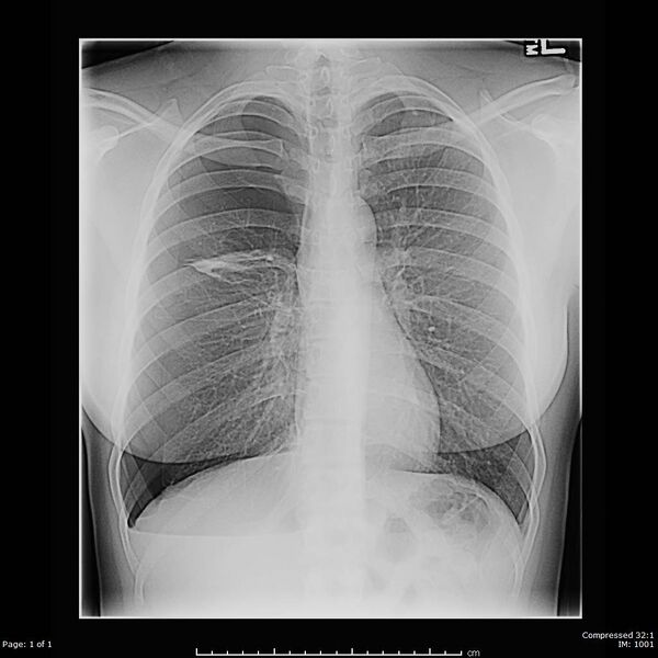 File:Catamenial pneumothorax (Radiopaedia 54382-60601 B 1).jpg