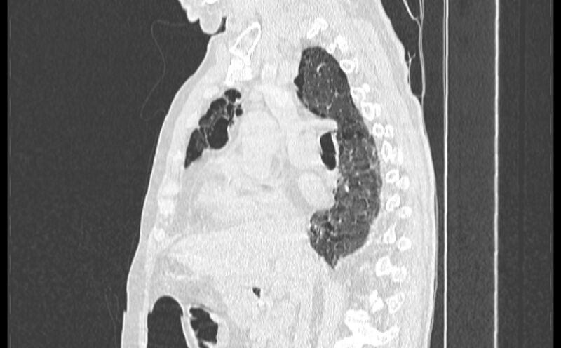 File:Cavitating bronchogenic carcinoma (Radiopaedia 44489-48162 Sagittal lung window 24).jpg