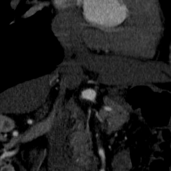 File:Celiac artery aneurysm (Radiopaedia 21574-21525 B 16).JPEG