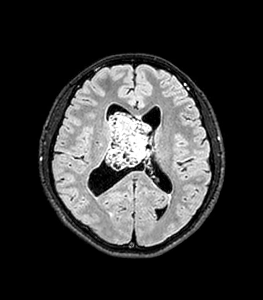 Central neurocytoma (Radiopaedia 79320-92380 Axial FLAIR 138).jpg