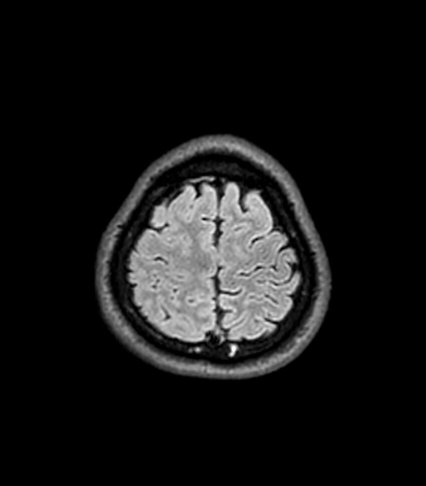 Central neurocytoma (Radiopaedia 79320-92380 Axial FLAIR 58).jpg