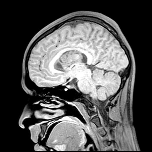 File:Central neurocytoma (Radiopaedia 79320-92380 Sagittal T1 121).jpg