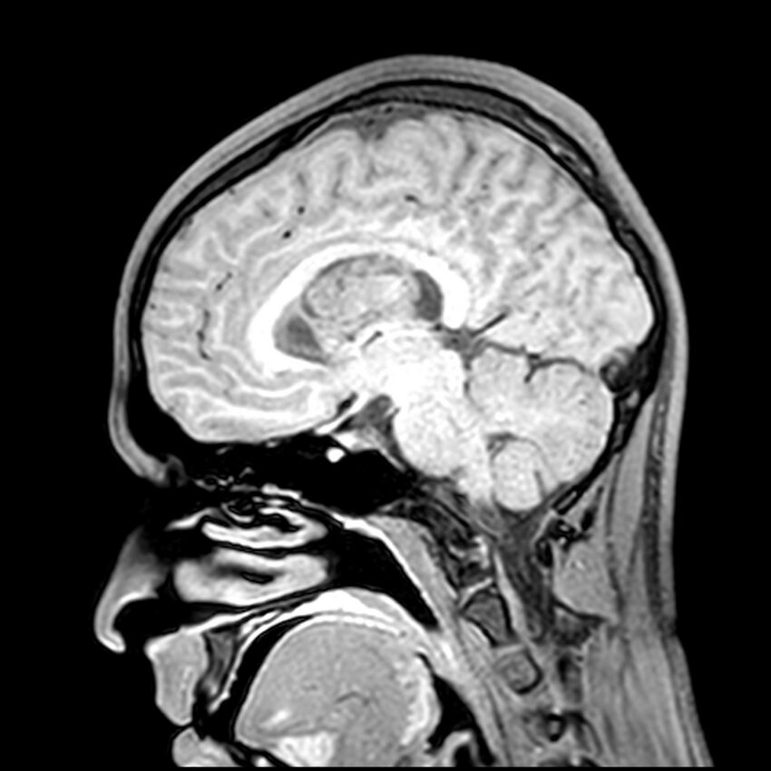 Central neurocytoma (Radiopaedia 79320-92380 Sagittal T1 121).jpg