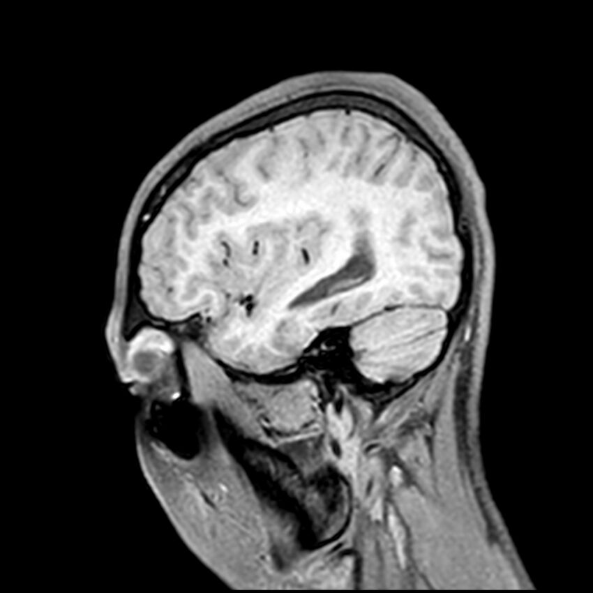 Central neurocytoma (Radiopaedia 79320-92380 Sagittal T1 198).jpg