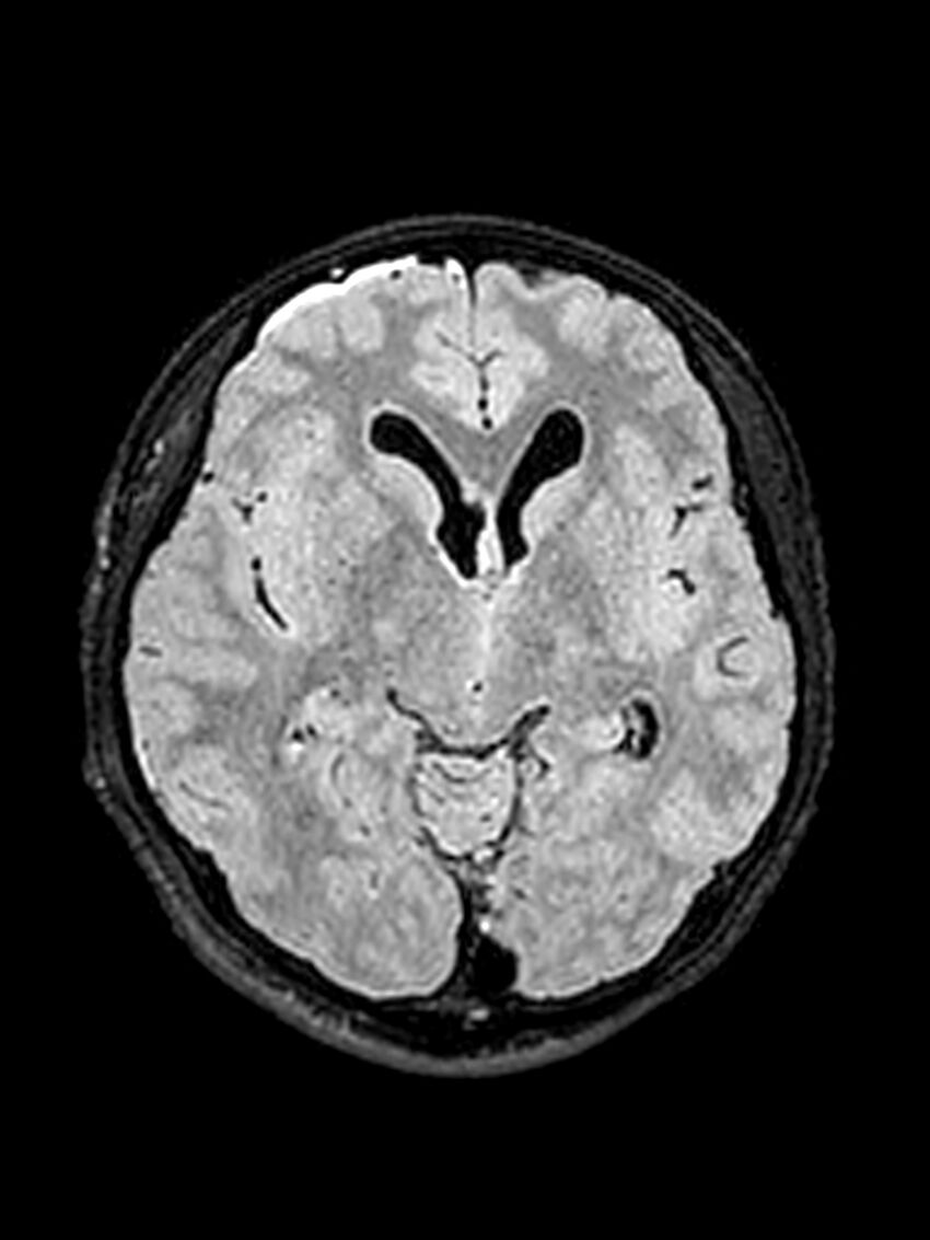 Central neurocytoma (Radiopaedia 79320-92381 Axial FLAIR 96).jpg