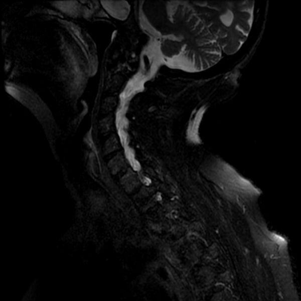 File:Cerebellar ataxia with neuropathy and vestibular areflexia syndrome (CANVAS) (Radiopaedia 74283-85159 Sagittal T2 fat sat 8).jpg