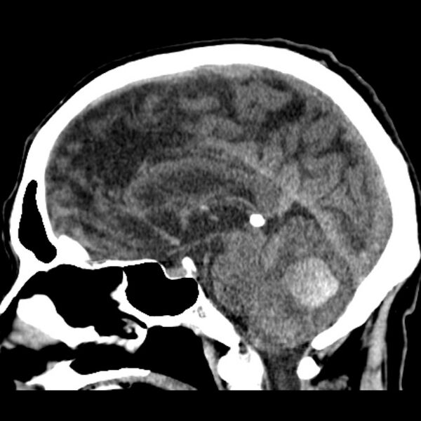 File:Cerebellar hemorrhage (Radiopaedia 27193-27359 C 23).jpg
