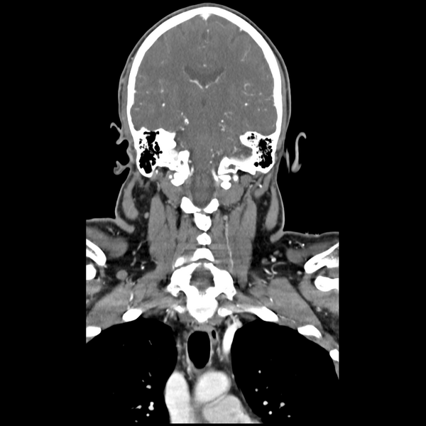 File:Cerebellar infarct due to vertebral artery dissection with posterior fossa decompression (Radiopaedia 82779-97029 D 36).png