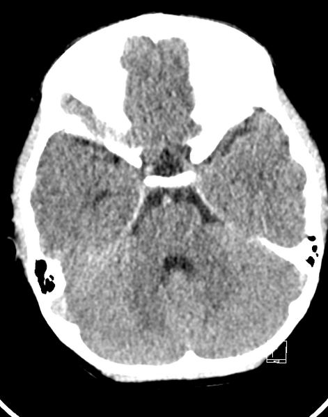 File:Cerebellar stroke (Radiopaedia 32202-33149 Axial non-contrast 6).png