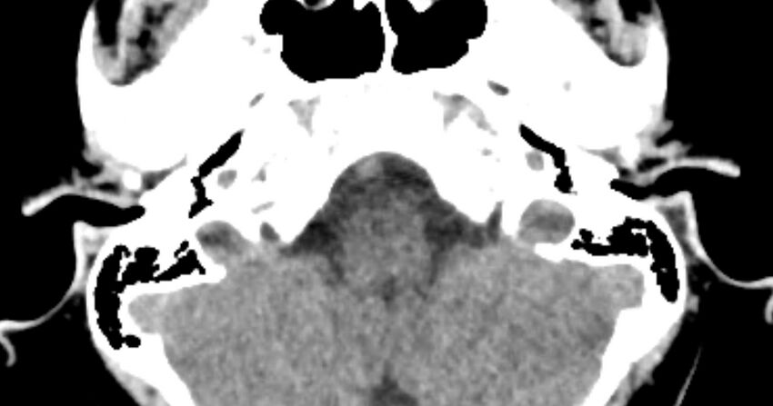 Cerebellopontine angle lipoma (Radiopaedia 57303-64242 B 19).jpg