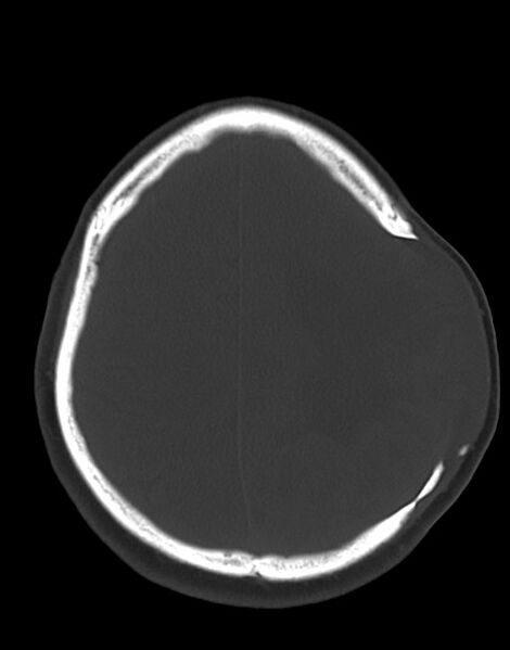 File:Cerebral abscesses (Radiopaedia 70458-80568 Axial bone window 46).jpg