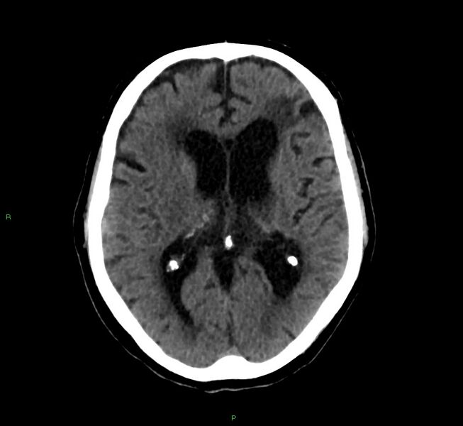 File:Cerebral amyloid angiopathy-associated lobar intracerebral hemorrhage (Radiopaedia 58376-65513 Axial non-contrast 26).jpg