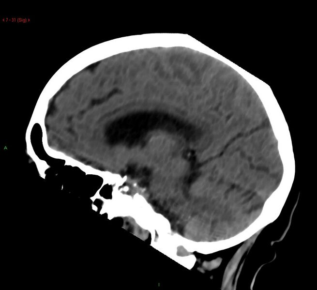 File:Cerebral amyloid angiopathy-associated lobar intracerebral hemorrhage (Radiopaedia 58378-65518 C 31).jpg
