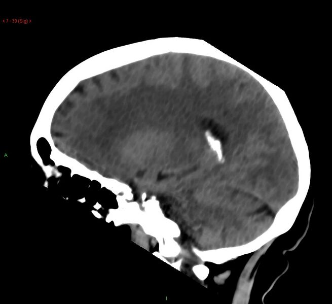 File:Cerebral amyloid angiopathy-associated lobar intracerebral hemorrhage (Radiopaedia 58378-65518 C 39).jpg