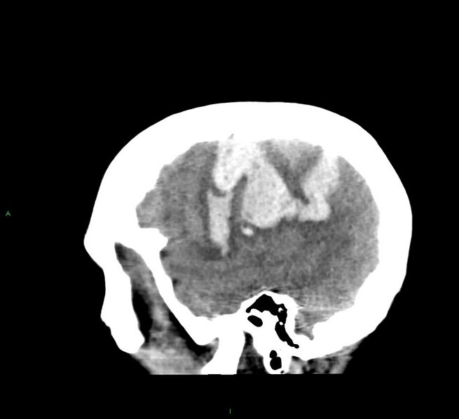 File:Cerebral amyloid angiopathy-associated lobar intracerebral hemorrhage (Radiopaedia 58379-65519 C 11).jpg