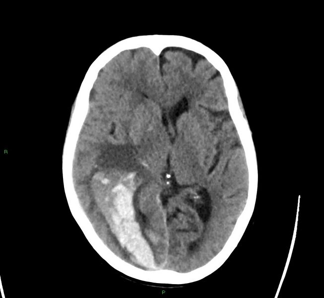 File:Cerebral amyloid angiopathy-associated lobar intracerebral hemorrhage (Radiopaedia 58563-65727 Axial non-contrast 29).jpg