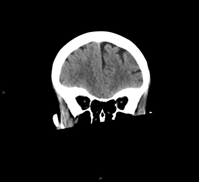 File:Cerebral amyloid angiopathy-associated lobar intracerebral hemorrhage (Radiopaedia 58563-65727 Coronal non-contrast 50).jpg