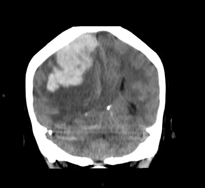 File:Cerebral amyloid angiopathy-associated lobar intracerebral hemorrhage (Radiopaedia 58751-65972 Coronal non-contrast 24).jpg