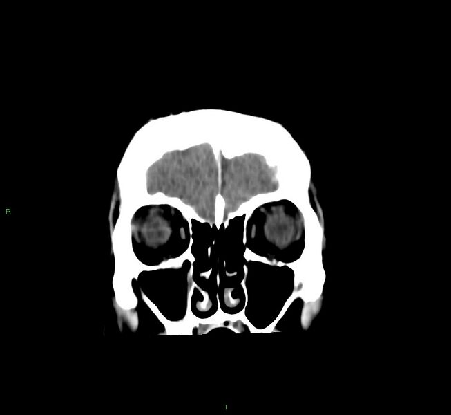 File:Cerebral amyloid angiopathy-associated lobar intracerebral hemorrhage (Radiopaedia 58756-65977 Coronal non-contrast 55).jpg