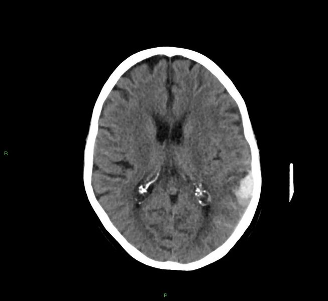 File:Cerebral amyloid angiopathy-associated lobar intracerebral hemorrhage (Radiopaedia 58757-65978 Axial non-contrast 25).jpg