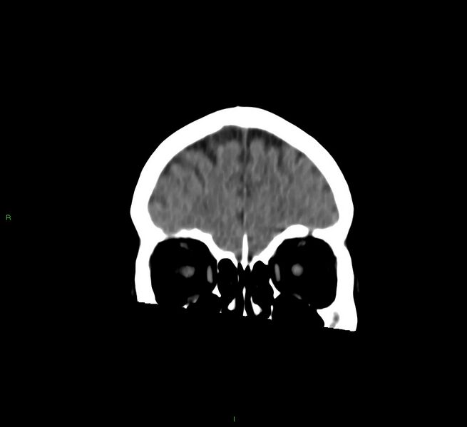 File:Cerebral amyloid angiopathy-associated lobar intracerebral hemorrhage (Radiopaedia 58757-65978 Coronal non-contrast 55).jpg