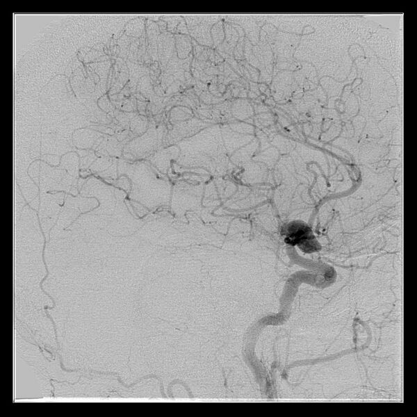 File:Cerebral aneurysm with rupture (Radiopaedia 29933-30458 LT CCA IC 43).jpg