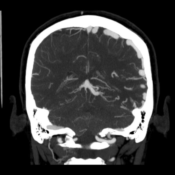 File:Cerebral arteriovenous malformation (Radiopaedia 43729-47189 C 32).jpg