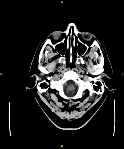 File:Cerebral autosomal dominant arteriopathy with subcortical infarcts and leukoencephalopathy (CADASIL) (Radiopaedia 86108-102051 Axial non-contrast 5).jpg