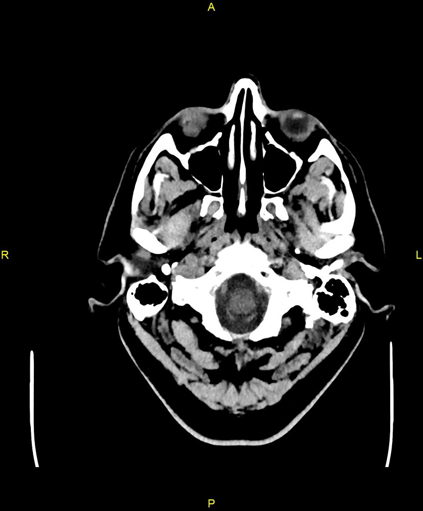 Cerebral autosomal dominant arteriopathy with subcortical infarcts and leukoencephalopathy (CADASIL) (Radiopaedia 86108-102051 Axial non-contrast 5).jpg