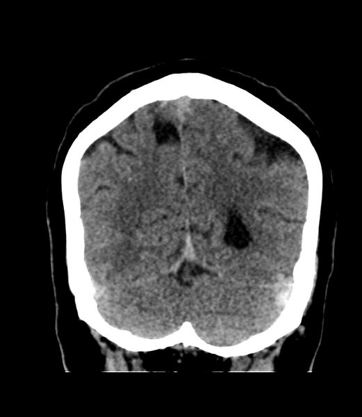 File:Cerebral dural venous sinus thrombosis (Radiopaedia 86514-102575 Coronal non-contrast 42).jpg