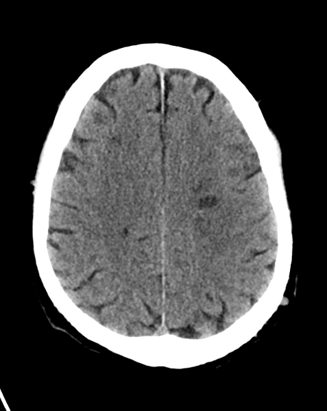 File:Cerebral embolic infarcts (embolic shower) (Radiopaedia 57395-64341 Axial non-contrast 22).png
