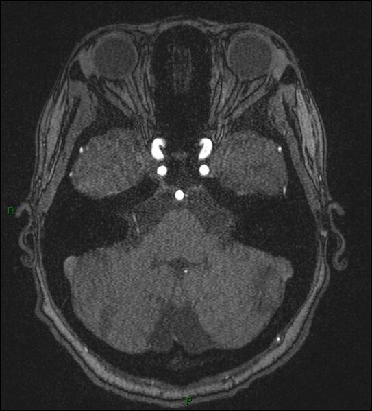 File:Cerebral fat embolism (Radiopaedia 35022-36525 Axial TOF 46).jpg
