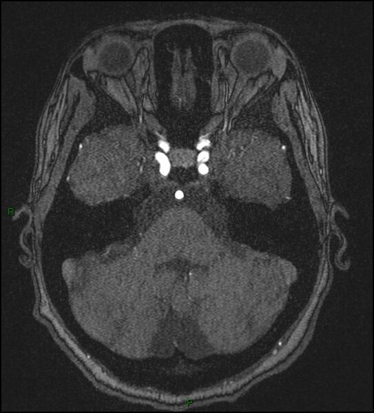 File:Cerebral fat embolism (Radiopaedia 35022-36525 Axial TOF 50).jpg